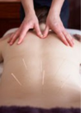 Photo of acupuncture treatment